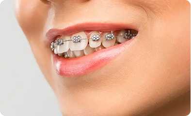 Orthodontic Treatment