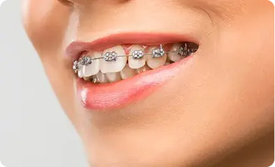 Orthodontic Treatment