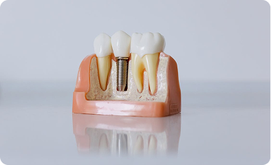 Dental Implants