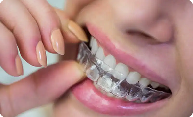 Invisalign / Aligners