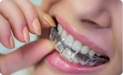 Invisalign / Aligners